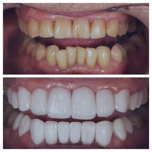Facette dentaire - Tout savoir, Type, Tarifs, Devis, Photos